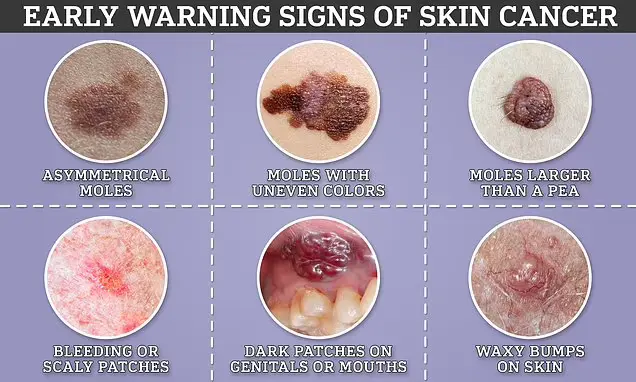 skin cancer signs Skin Cancer Signs