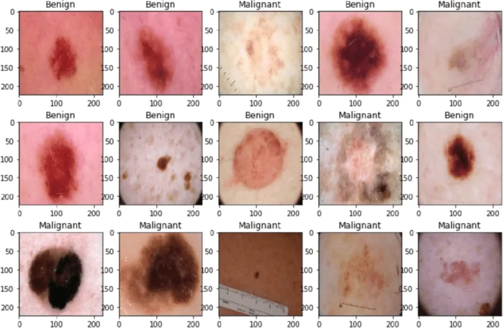 skin cancer type Skin Cancer Type